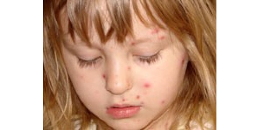 Ветрянка по заказу