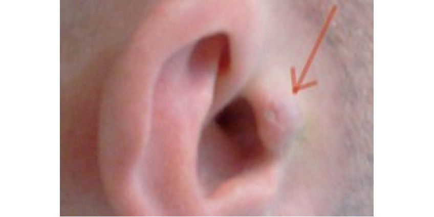 Житель Невады вшил в ухо динамик