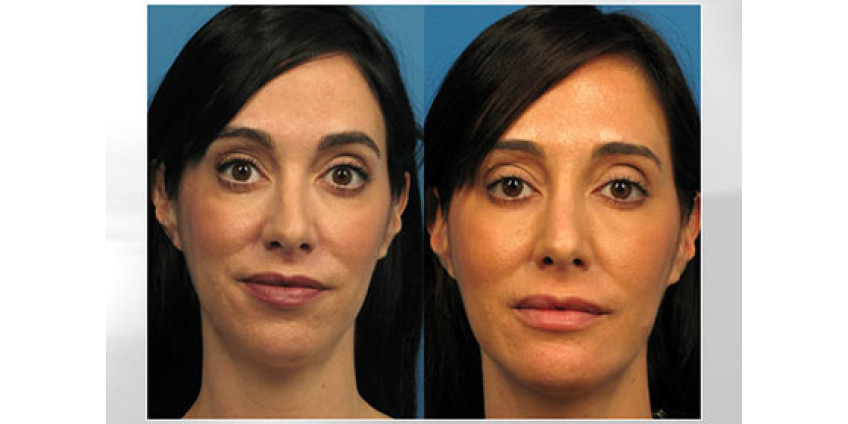 Жительница Лос-Анджелеса сделала три пластики радо хороших фото