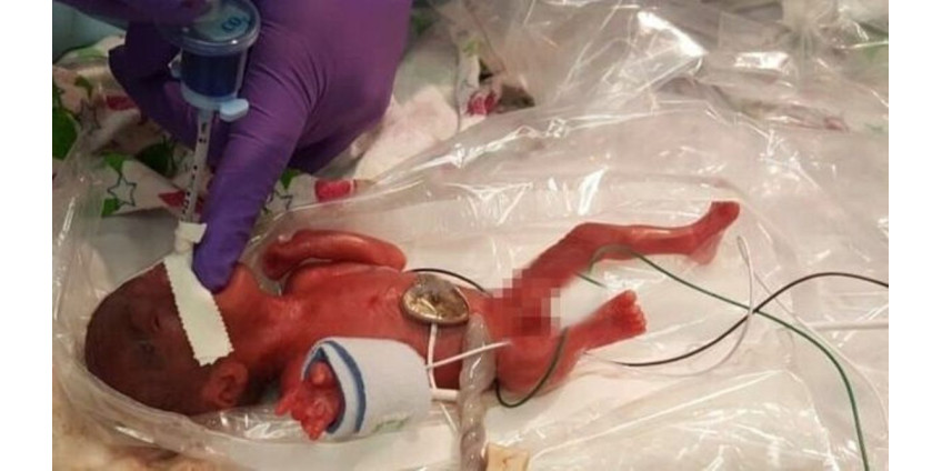 Самый маленький недоношенный ребенок в мире был выписан из больницы в Сан-Диего