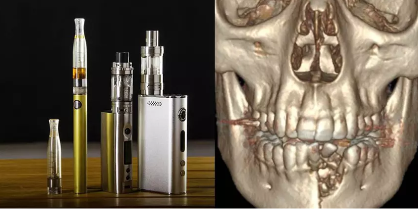 Электронная сигарета выбила подростку из Невады зубы и сломала челюсть