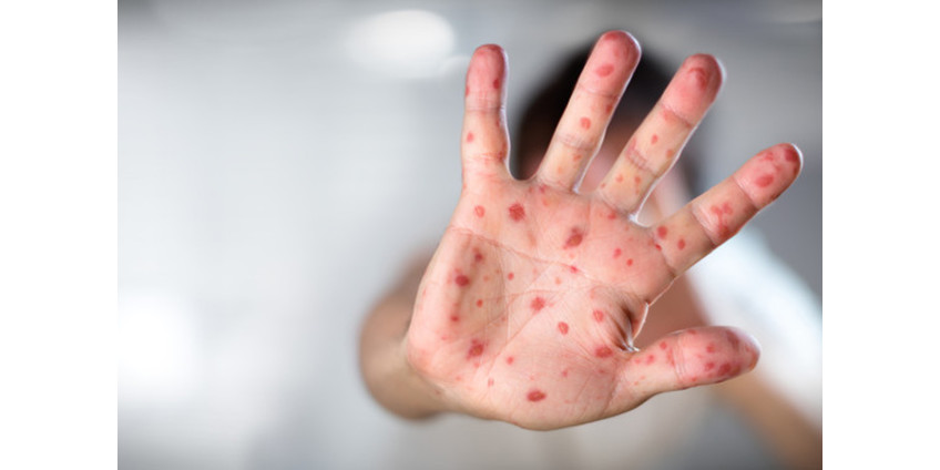 В Якутске выявлено 68 случаев заболевания корью