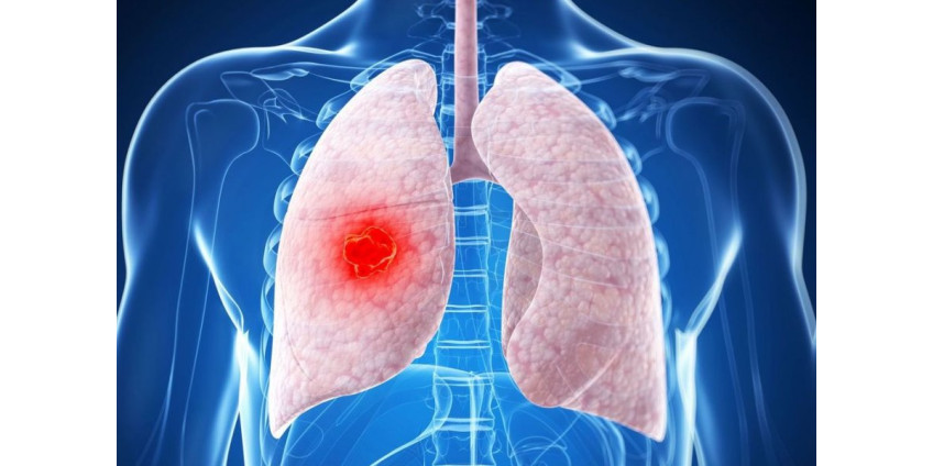 Медики нашли мощное оружие против одного из самых агрессивных типов рака