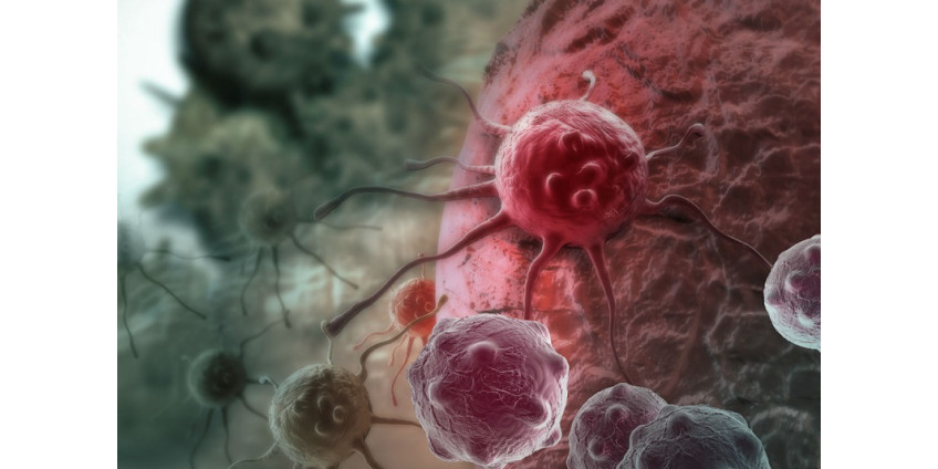 Названы признаки одного из самых агрессивных видов рака на ранней стадии
