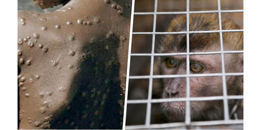 ВОЗ сообщила о более 550 подтвержденных случаях оспы обезьян в 30 странах