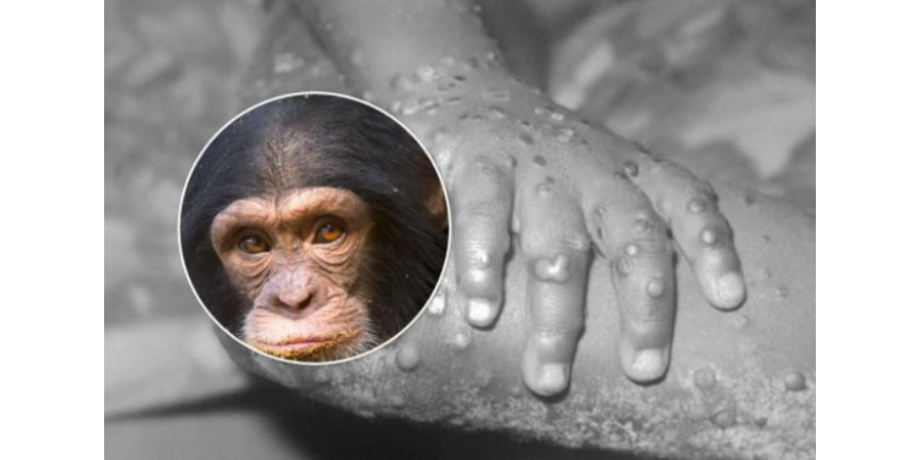 В Сан-Диего выявлены два возможных случая оспы обезьян