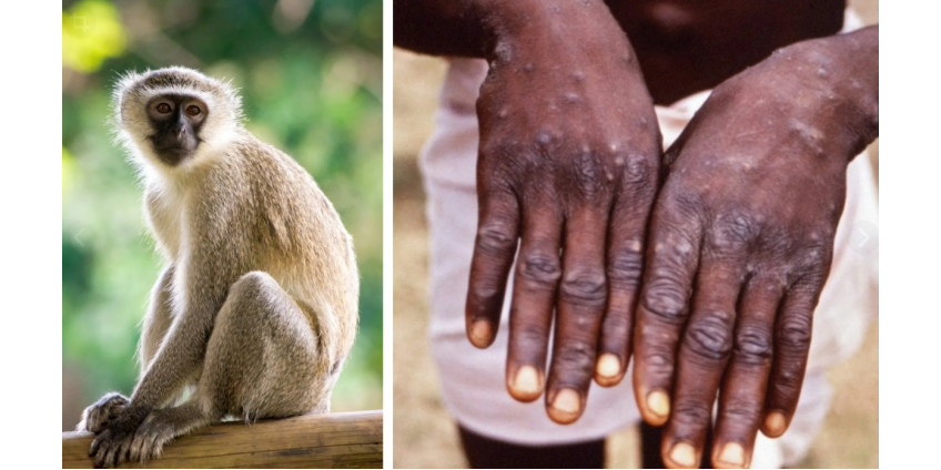 Жителям Сан-Диего предложили подписаться на текстовые оповещения об оспе обезьян