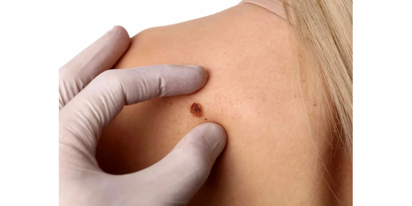 Обнаружены все необходимые для роста меланомы факторы