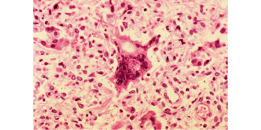 Подтвержден первый случай заболевания корью в округе Сан-Диего с 2019 года