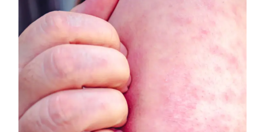 Случай заболевания корью подтвержден в округе Лос-Анджелес