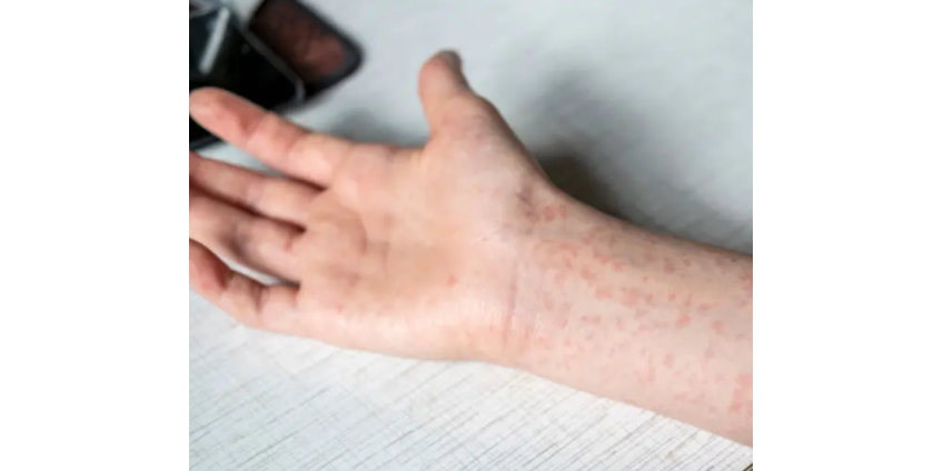 В округе Лос-Анджелес ребёнок умер от осложнений после кори