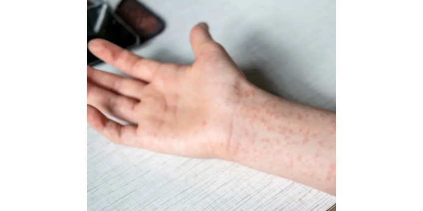 В аэропорту Лас-Вегаса у пассажира выявили случай кори 